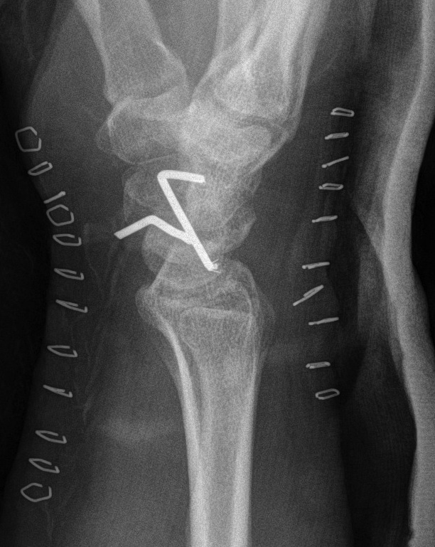 Perilunate Dislocation ORIF Lateral